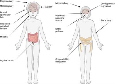 Sex difference contributes to phenotypic diversity in individuals with neurodevelopmental disorders